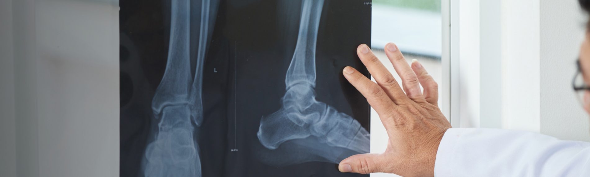 Healthcare professional examining an x-ray of an OA patient's ankle